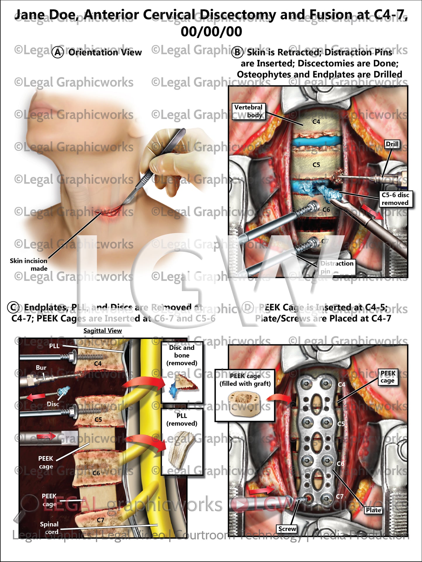 Anterior Cervical Discectomy and Fusion at C4-7