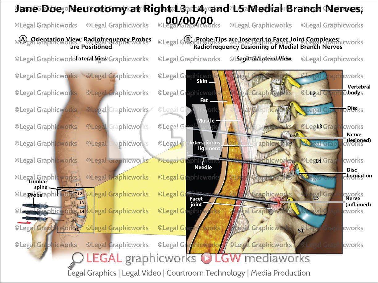 Neurotomy at Right L3, L4, and L5 Medial Branch Nerves