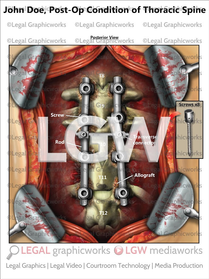 Post-Op Condition of Thoracic Spine