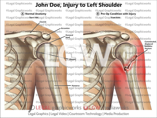 Injury to Left Shoulder