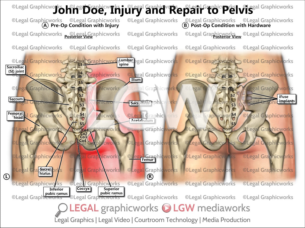 Injury and Repair to Pelvis