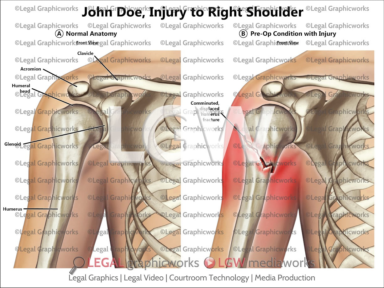 Injury to Right Shoulder