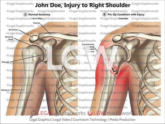 Injury to Right Shoulder