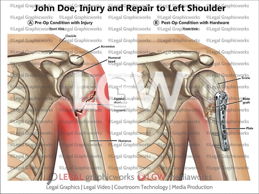 Injury and Repair to Left Shoulder