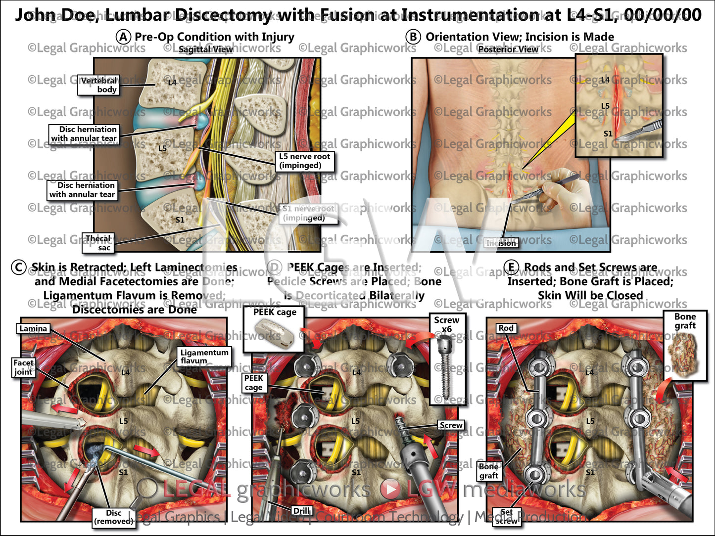Lumbar Discectomy with Fusion at Instrumentation at L4-S1