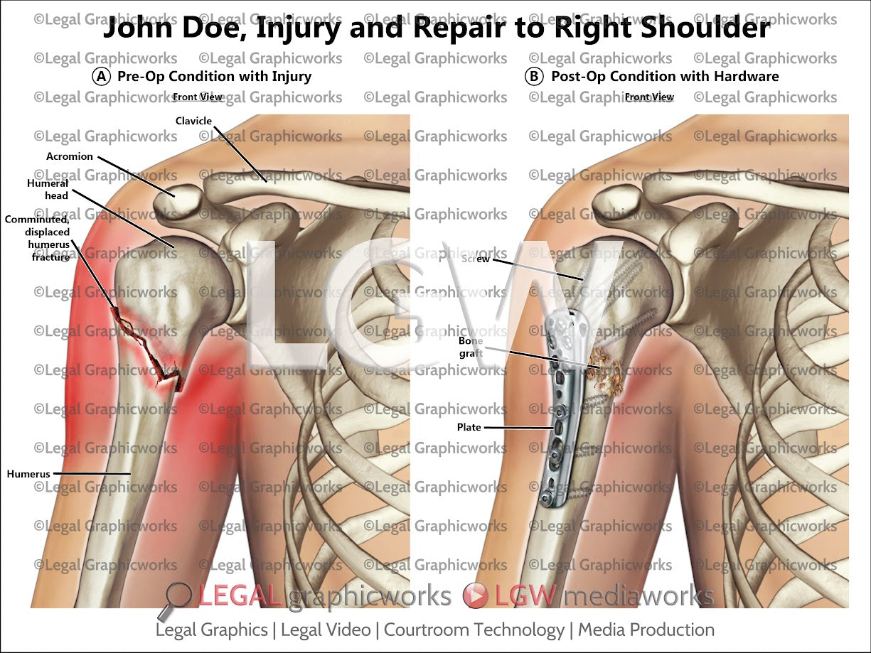 Injury and Repair to Right Shoulder