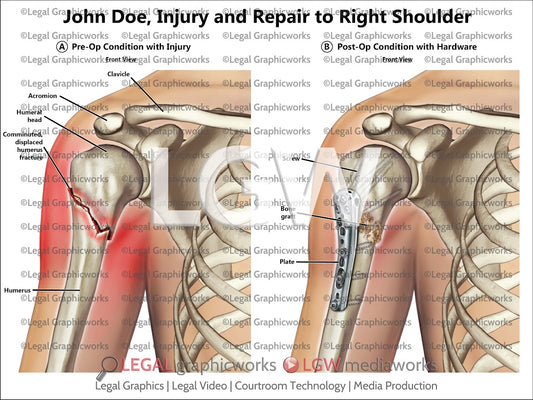 Injury and Repair to Right Shoulder