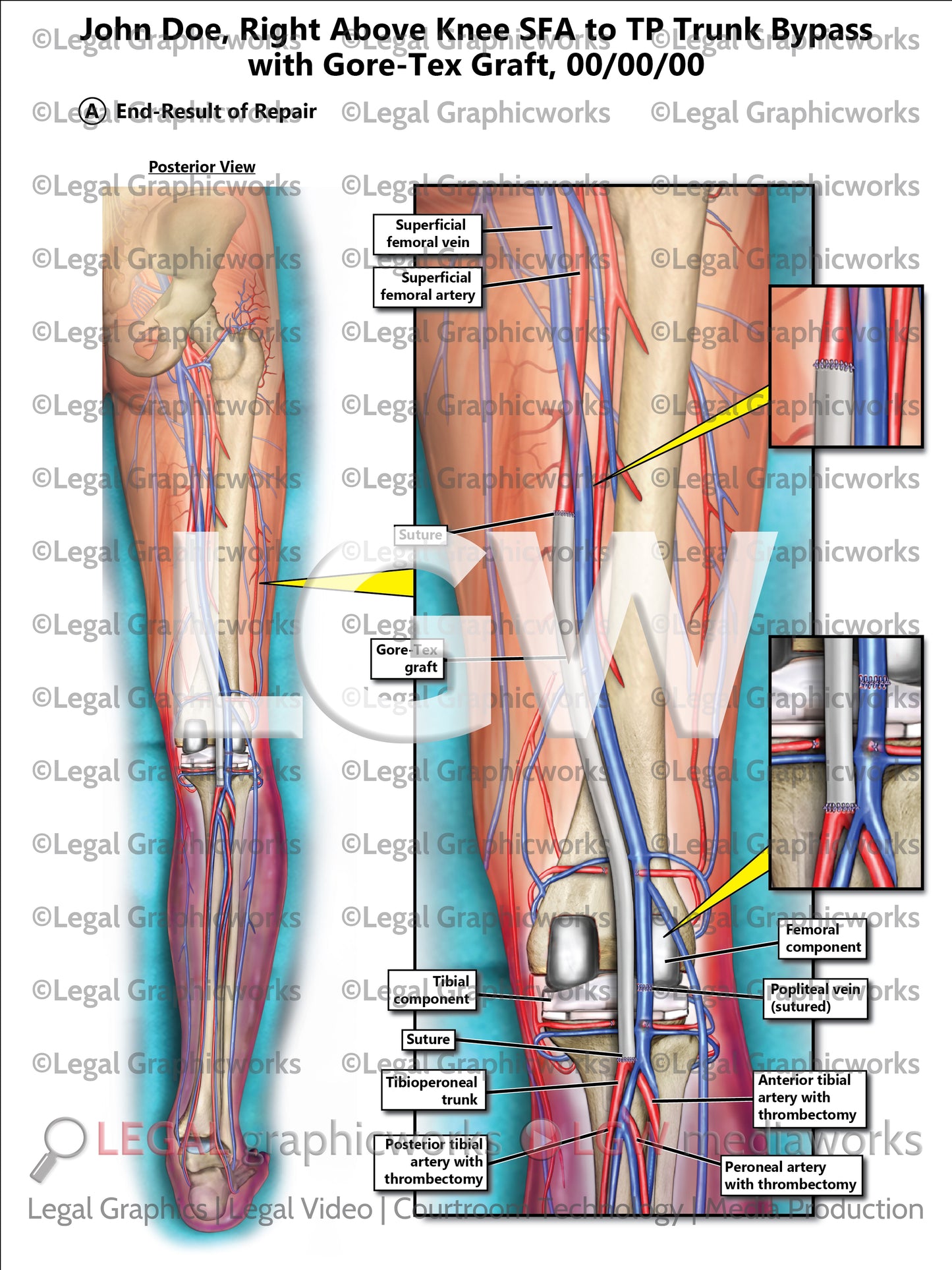 Right Above Knee SFA to TP Trunk Bypass with Gore-Tex Graft