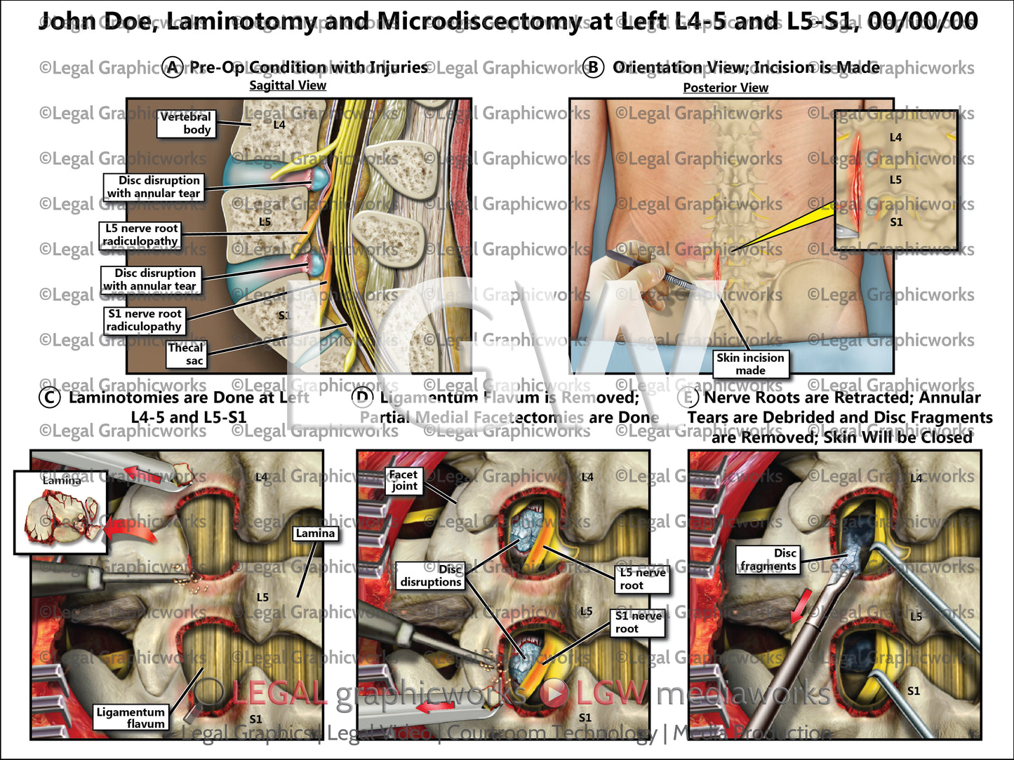 Laminotomy and Microdiscectomy at Left L4-5 and L5-S1
