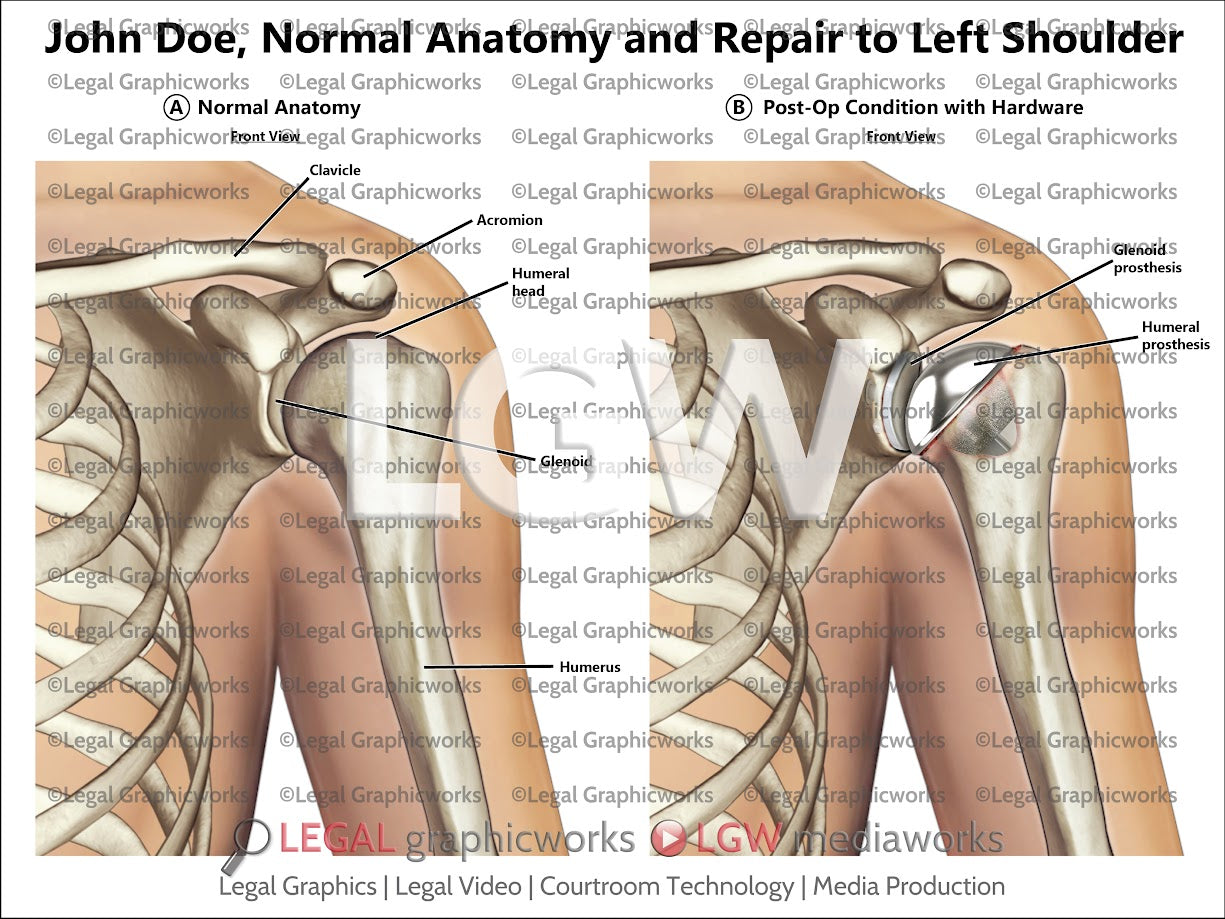 Normal Anatomy and Repair to Left Shoulder