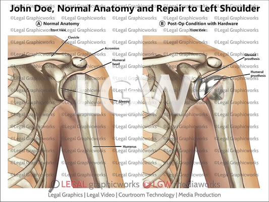 Normal Anatomy and Repair to Left Shoulder