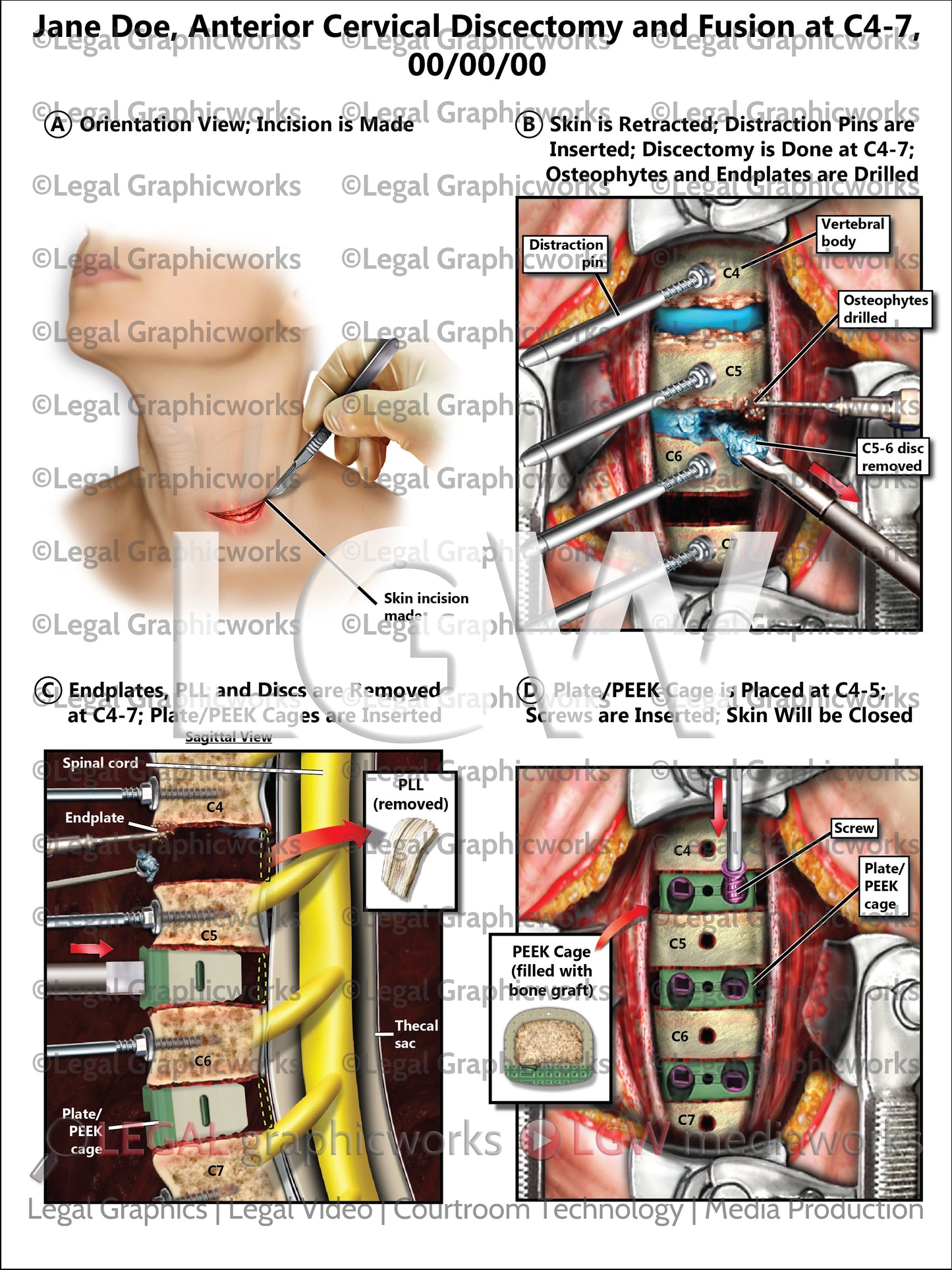 Anterior Cervical Discectomy and Fusion at C4-7