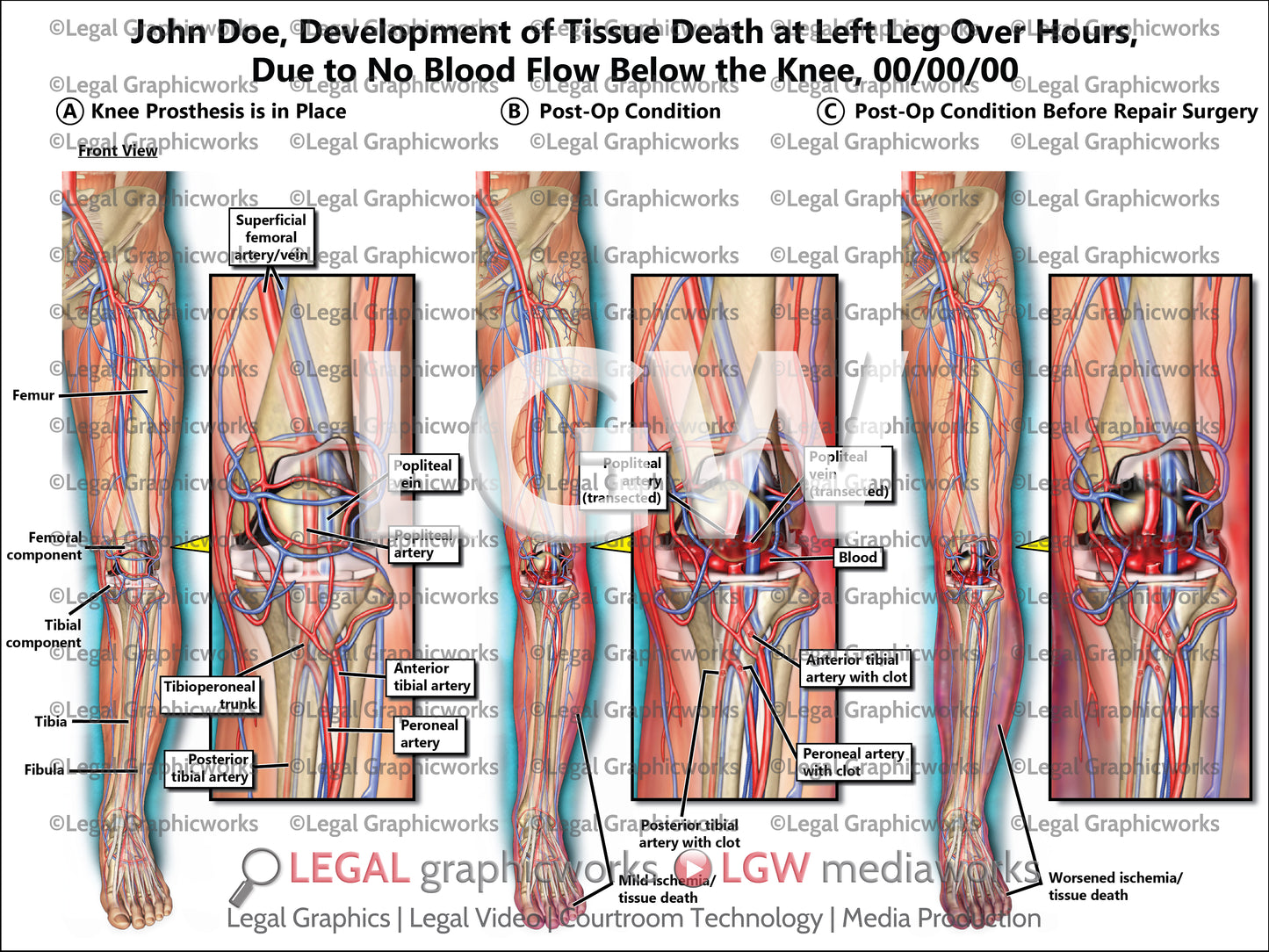 Development of Tissue Death at Left Leg Over Hours, Due to No Blood Flow Below the Knee