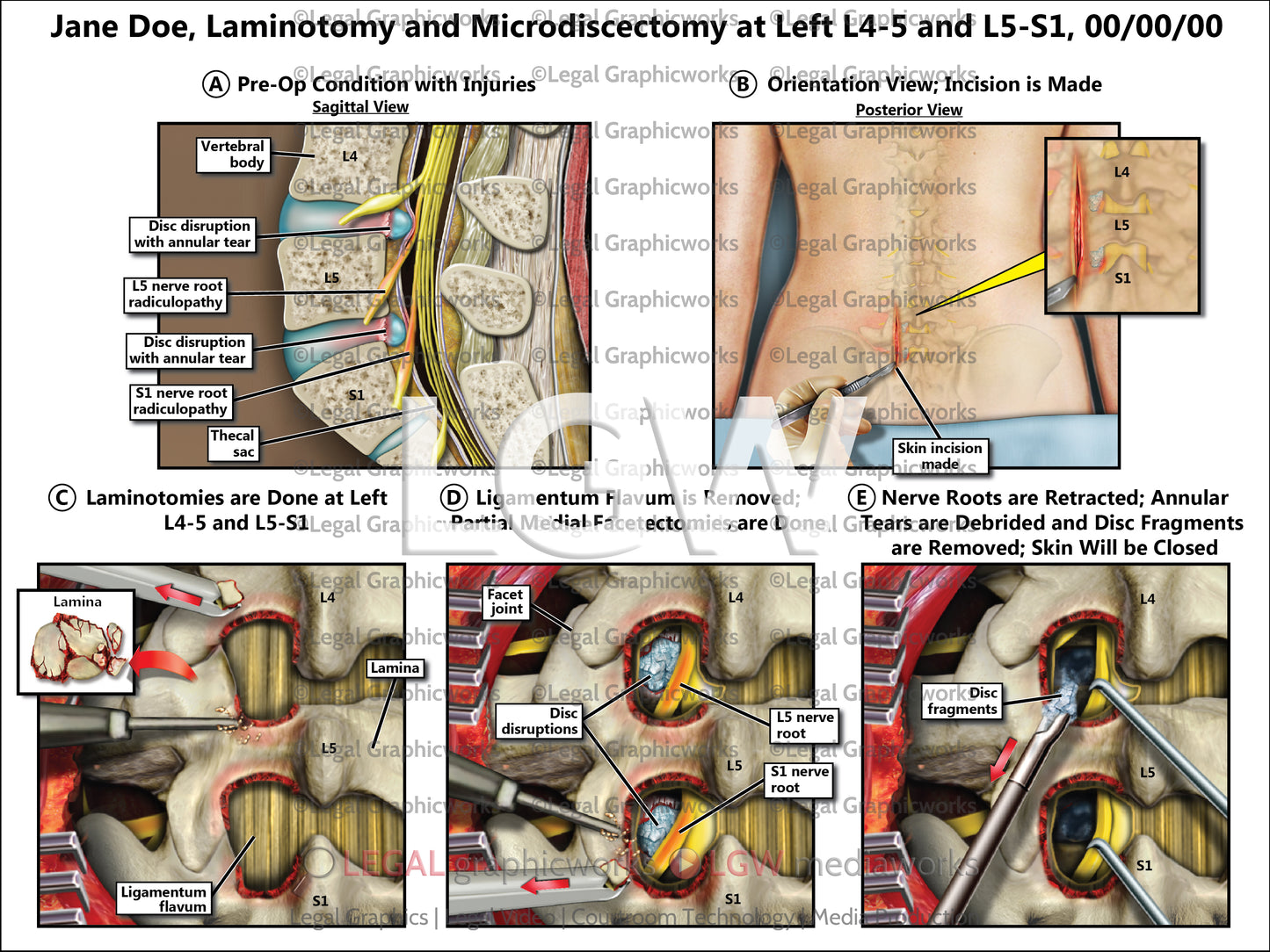 Laminotomy and Microdiscectomy at Left L4-5 and L5-S1
