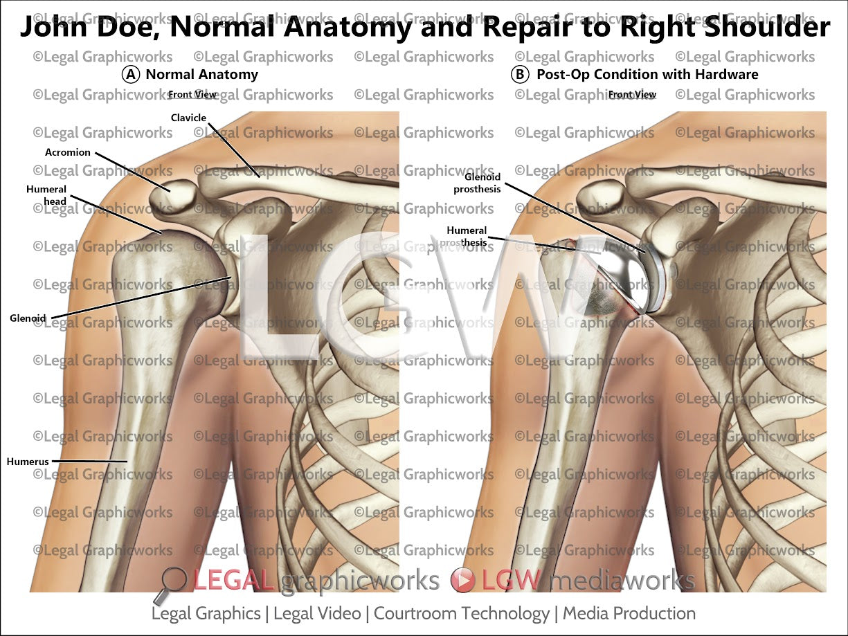 Normal Anatomy and Repair to Right Shoulder
