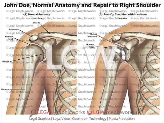 Normal Anatomy and Repair to Right Shoulder