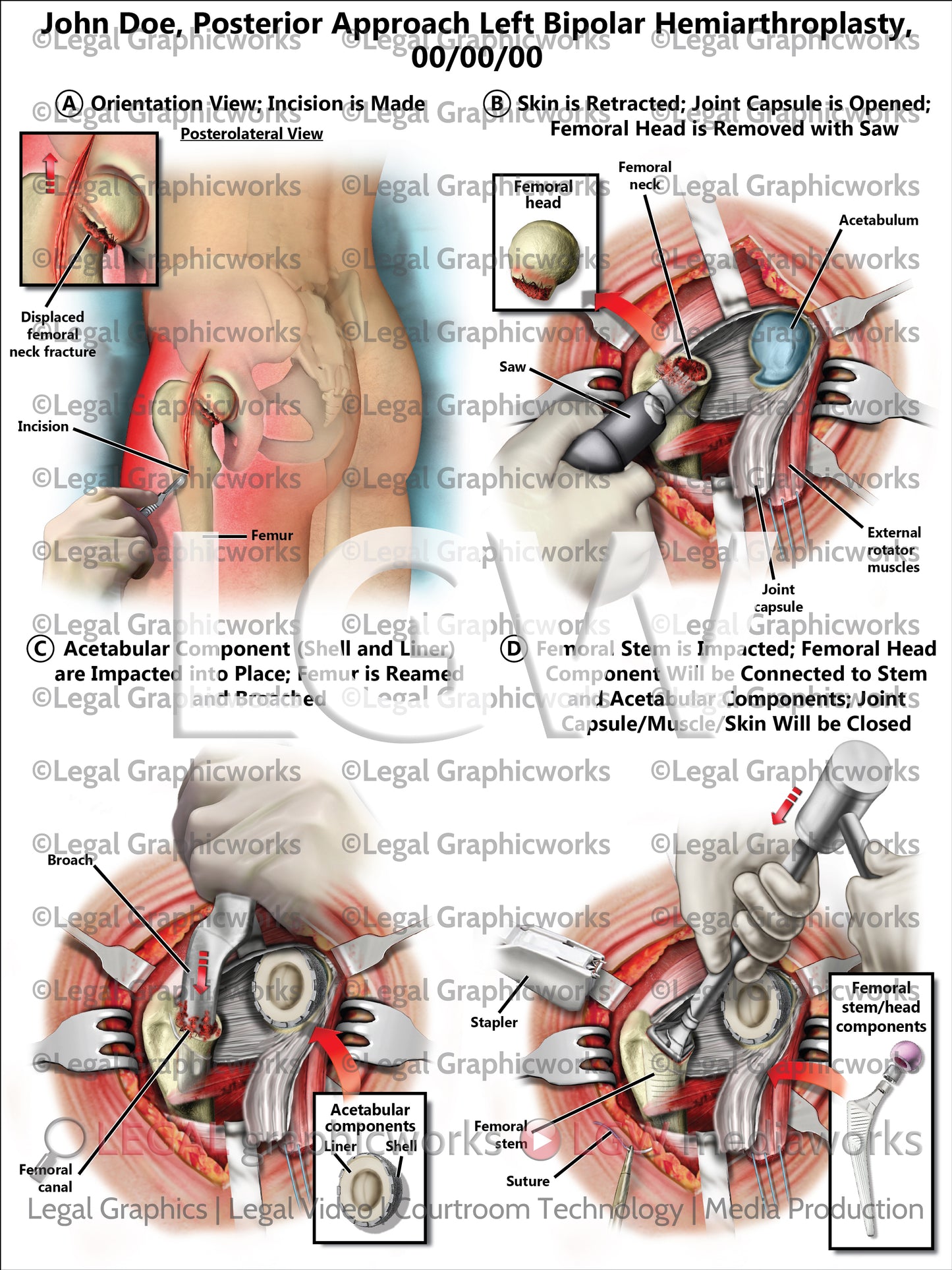 Posterior Approach Left Bipolar Hemiarthroplasty
