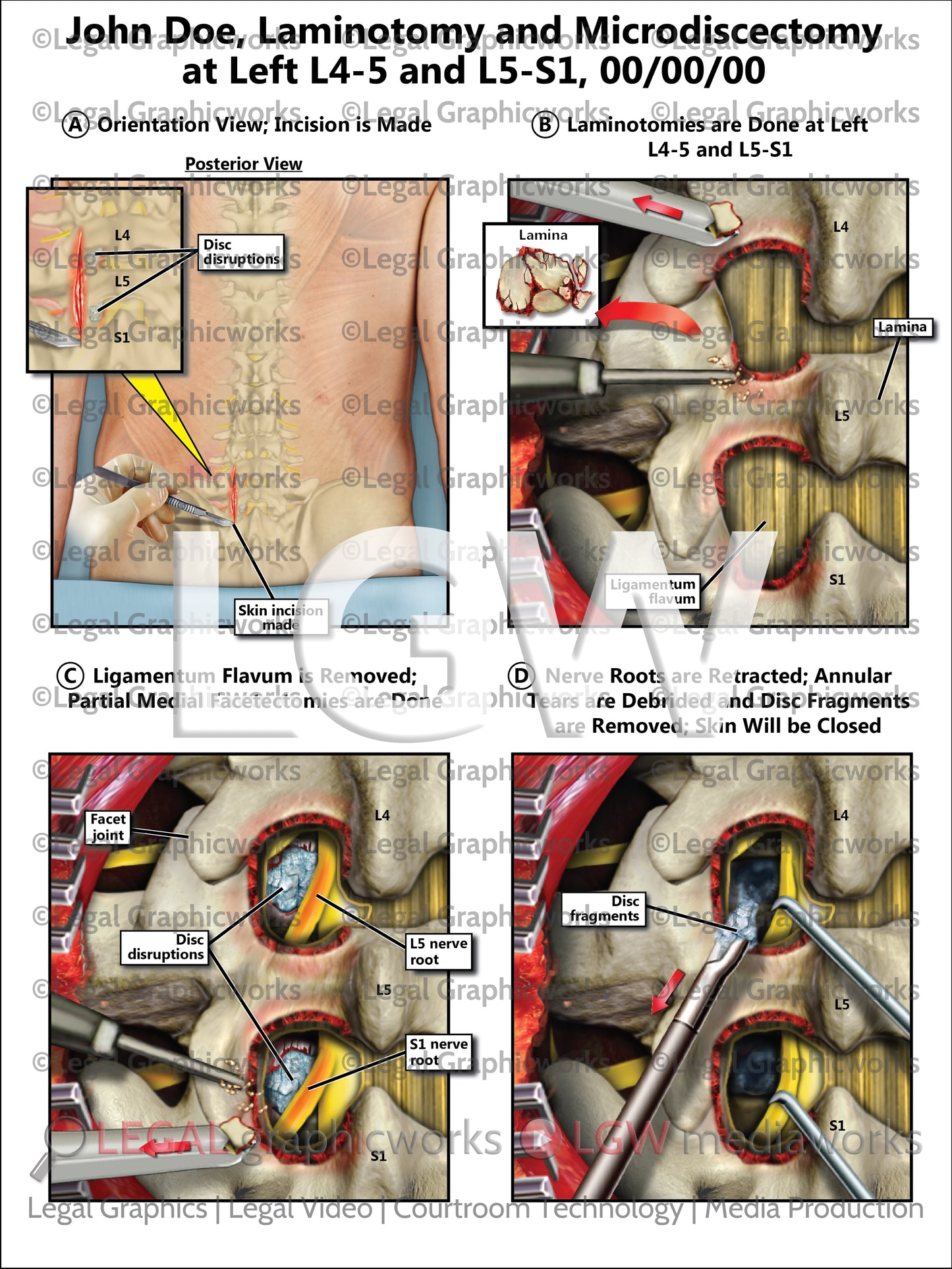 Laminotomy and Microdiscectomy at Left L4-5 and L5-S1