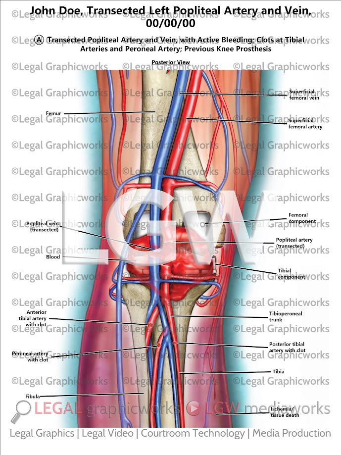 Transected Left Popliteal Artery and Vein