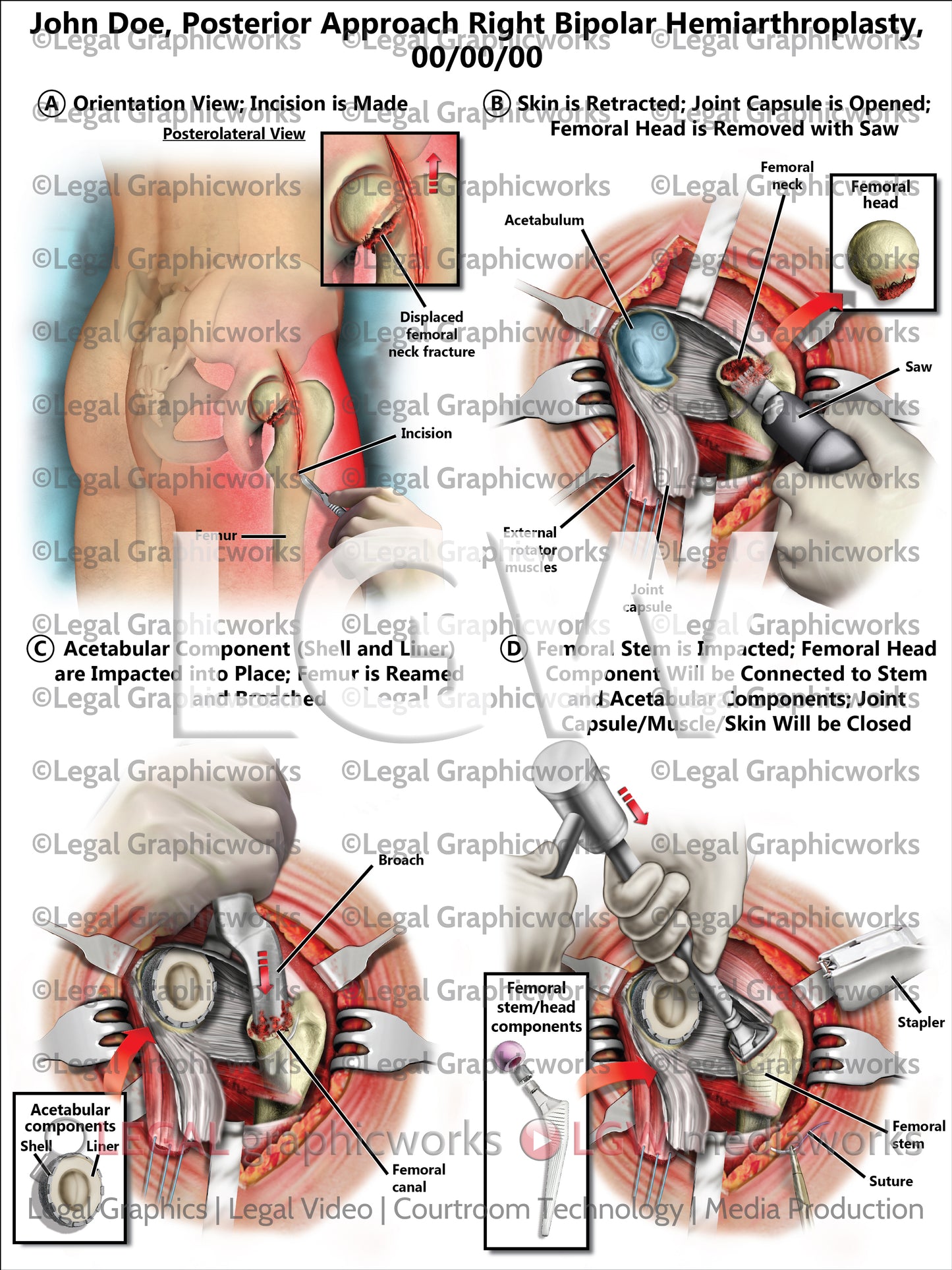 Posterior Approach Right Bipolar Hemiarthroplasty