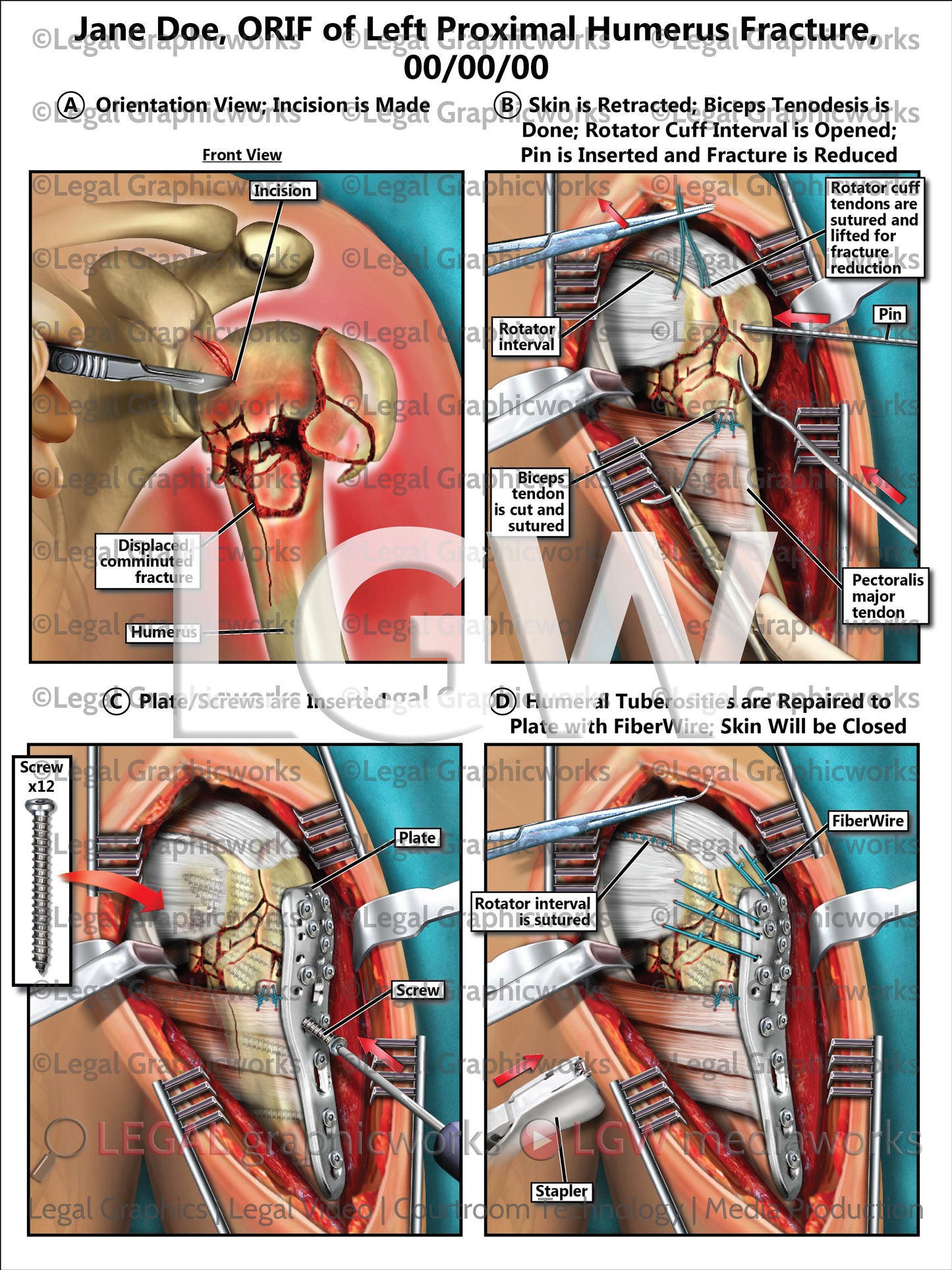 ORIF of Left Proximal Humerus Fracture
