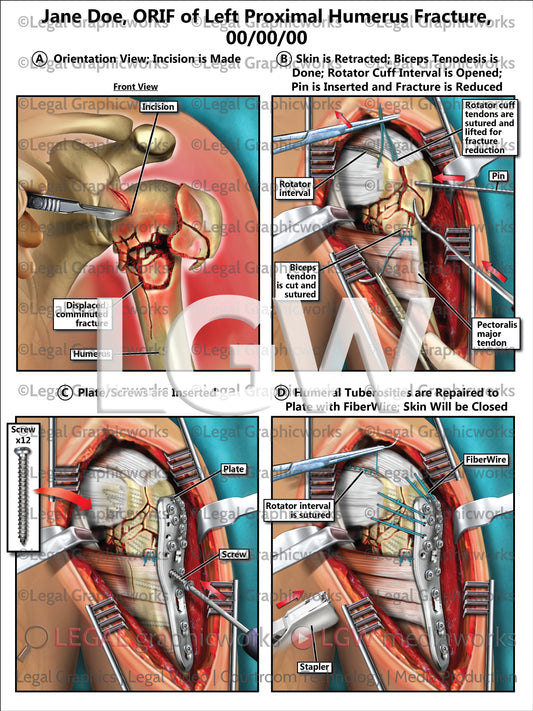 ORIF of Left Proximal Humerus Fracture