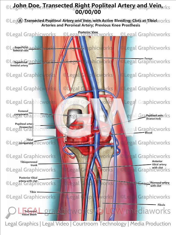 Transected Right Popliteal Artery and Vein