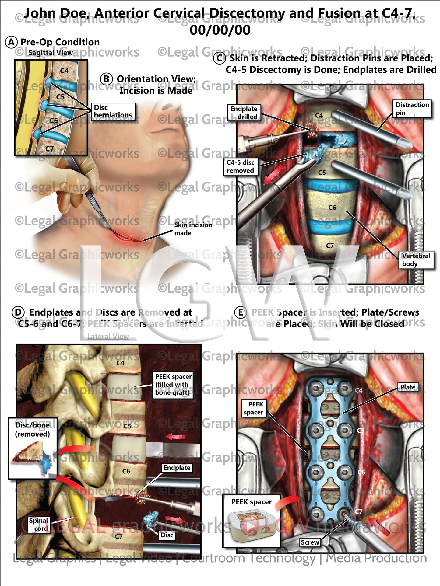 Anterior Cervical Discectomy and Fusion at C4-7