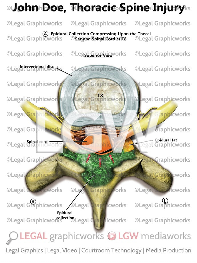 Thoracic Spine Injury
