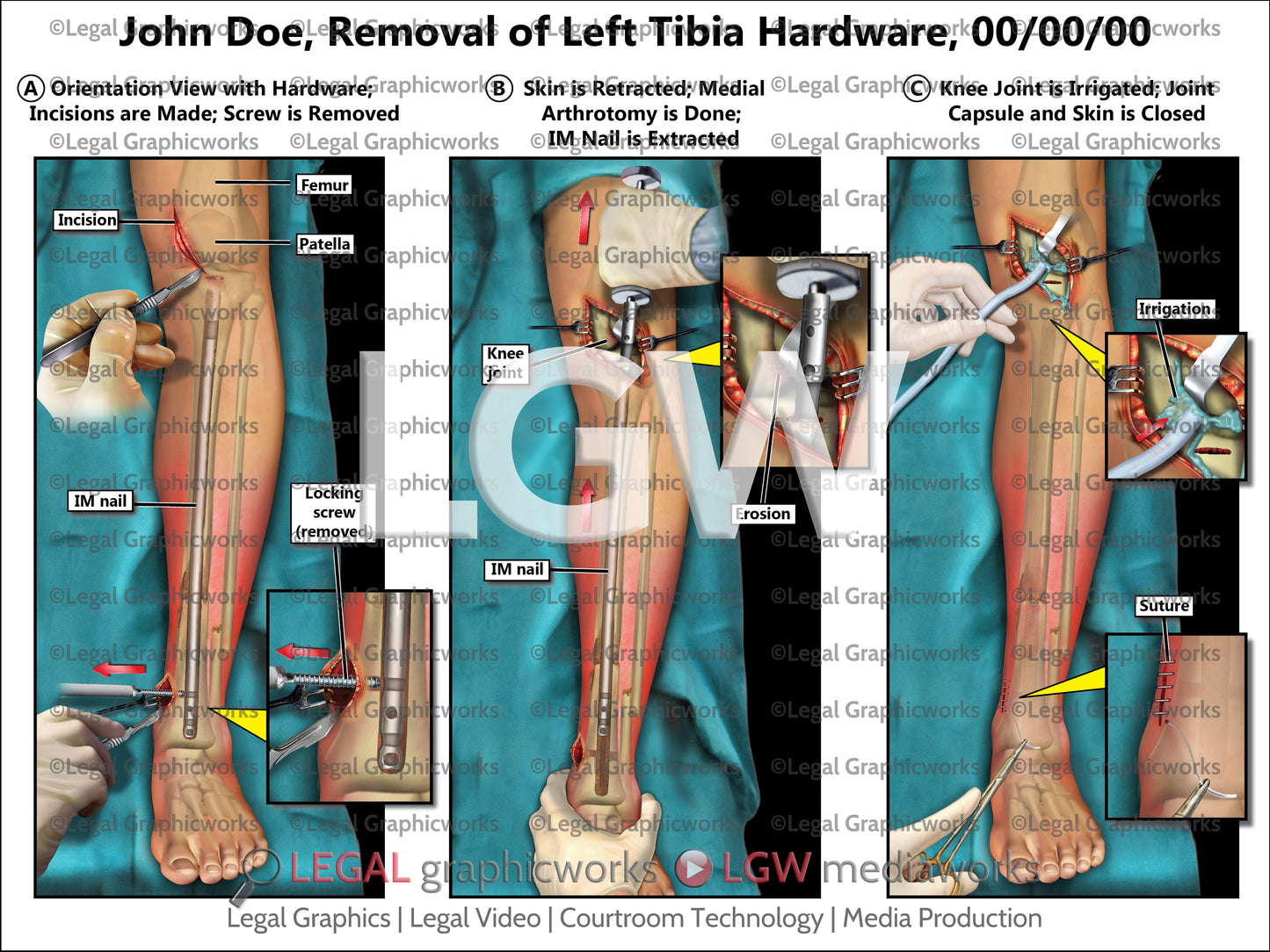 Removal of Left Tibia Hardware