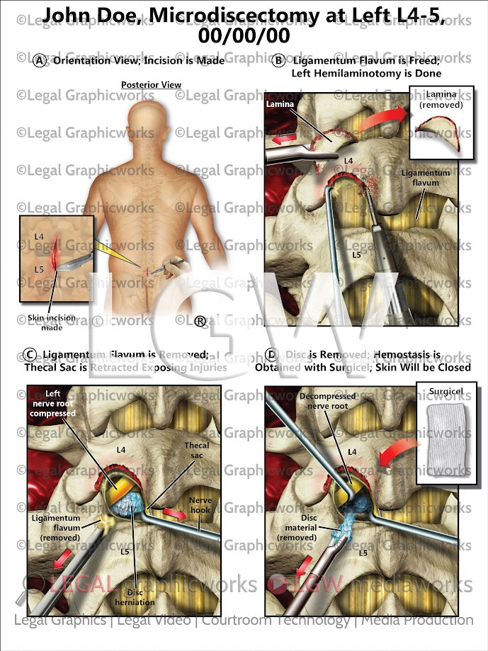 Microdiscectomy at Left L4-5