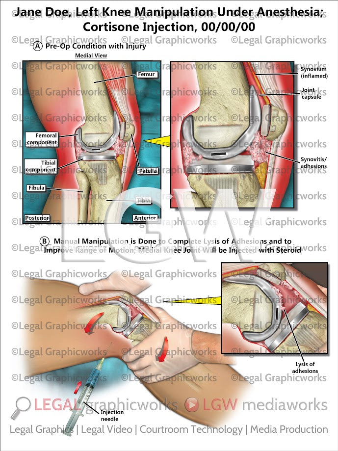 Left Knee Manipulation under Anesthesia; Cortisone Injection