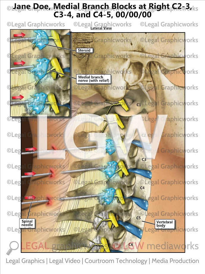 Medial Branch Blocks at Right C2-3, C3-4, and C4-5
