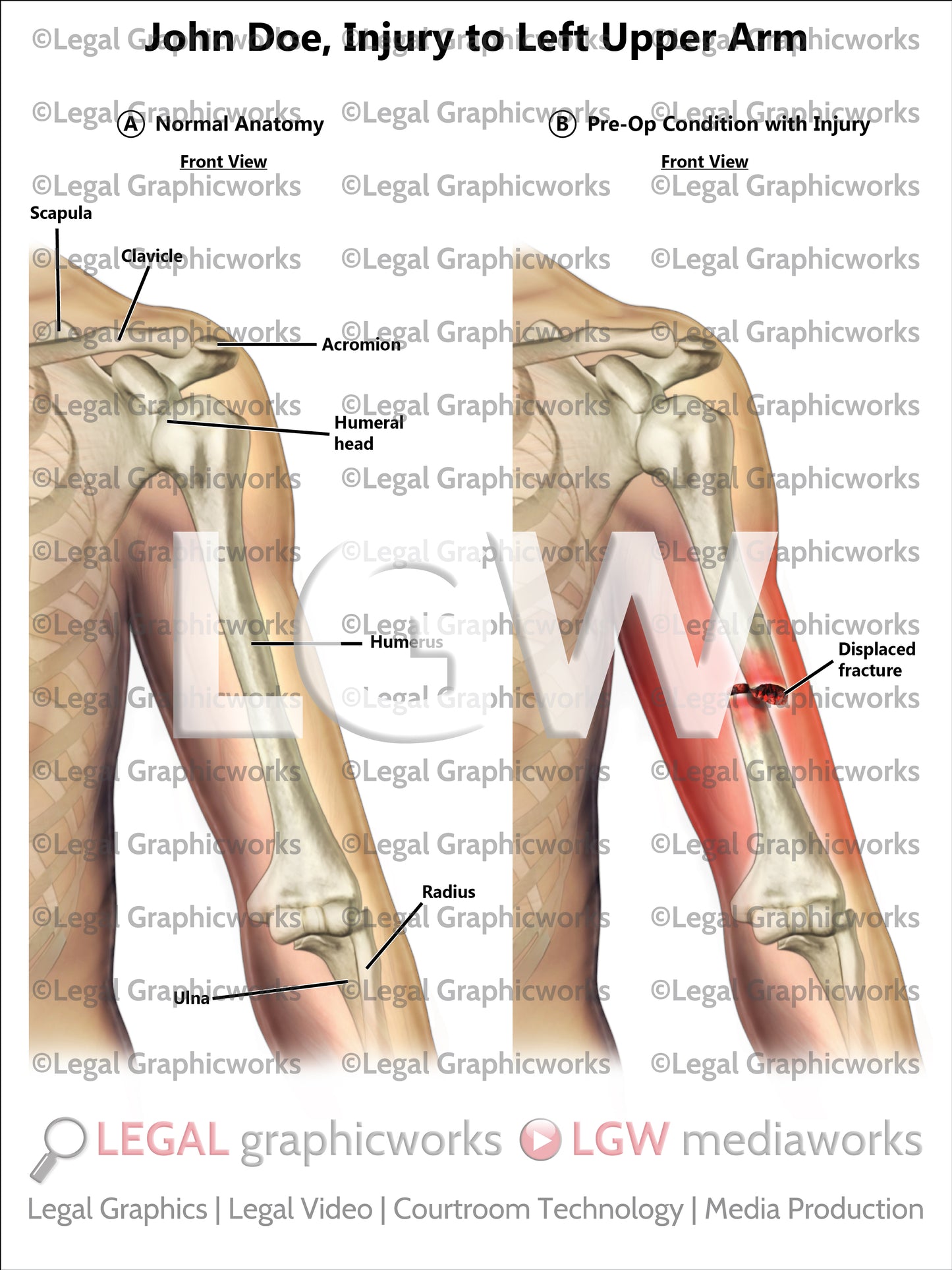 Injury to Left Upper Arm
