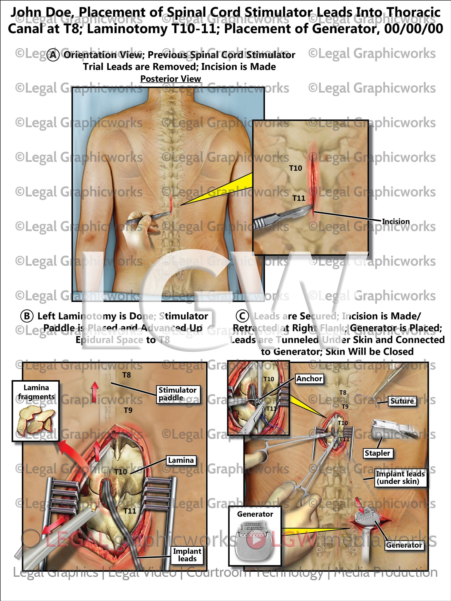 Placement of Spinal Cord Stimulator Leads Into Thoracic Canal at T8; Laminotomy T10-11; Placement of Generator