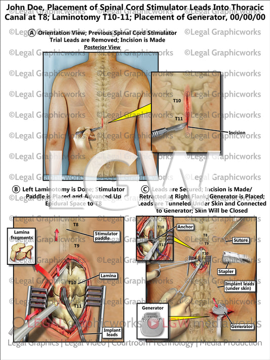 Placement of Spinal Cord Stimulator Leads Into Thoracic Canal at T8; Laminotomy T10-11; Placement of Generator