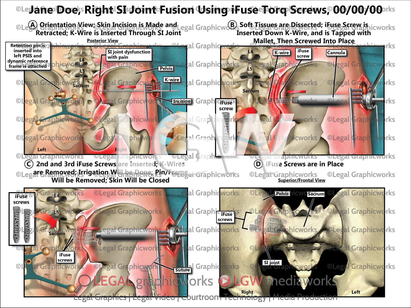 Right SI Joint Fusion Using iFuse Torq Screws