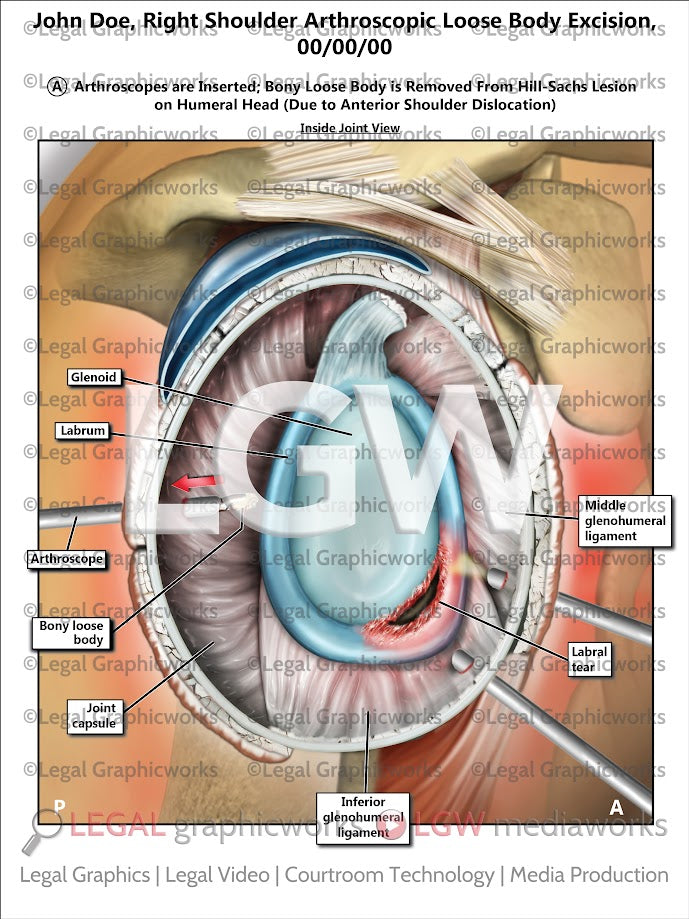 Right Shoulder Arthroscopic Loose Body Excision