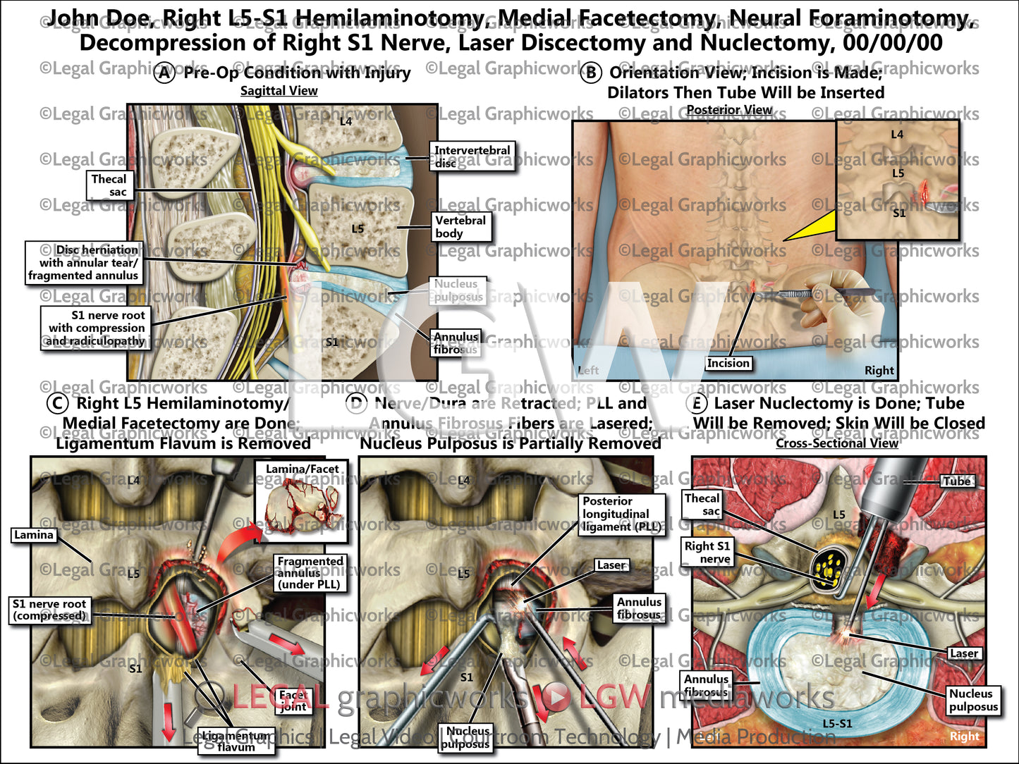 Right L5-S1 Hemilaminotomy, Medial Facetectomy, Neural Foraminotomy, Decompression of Right S1 Nerve, Laser Discectomy and Nuclectomy