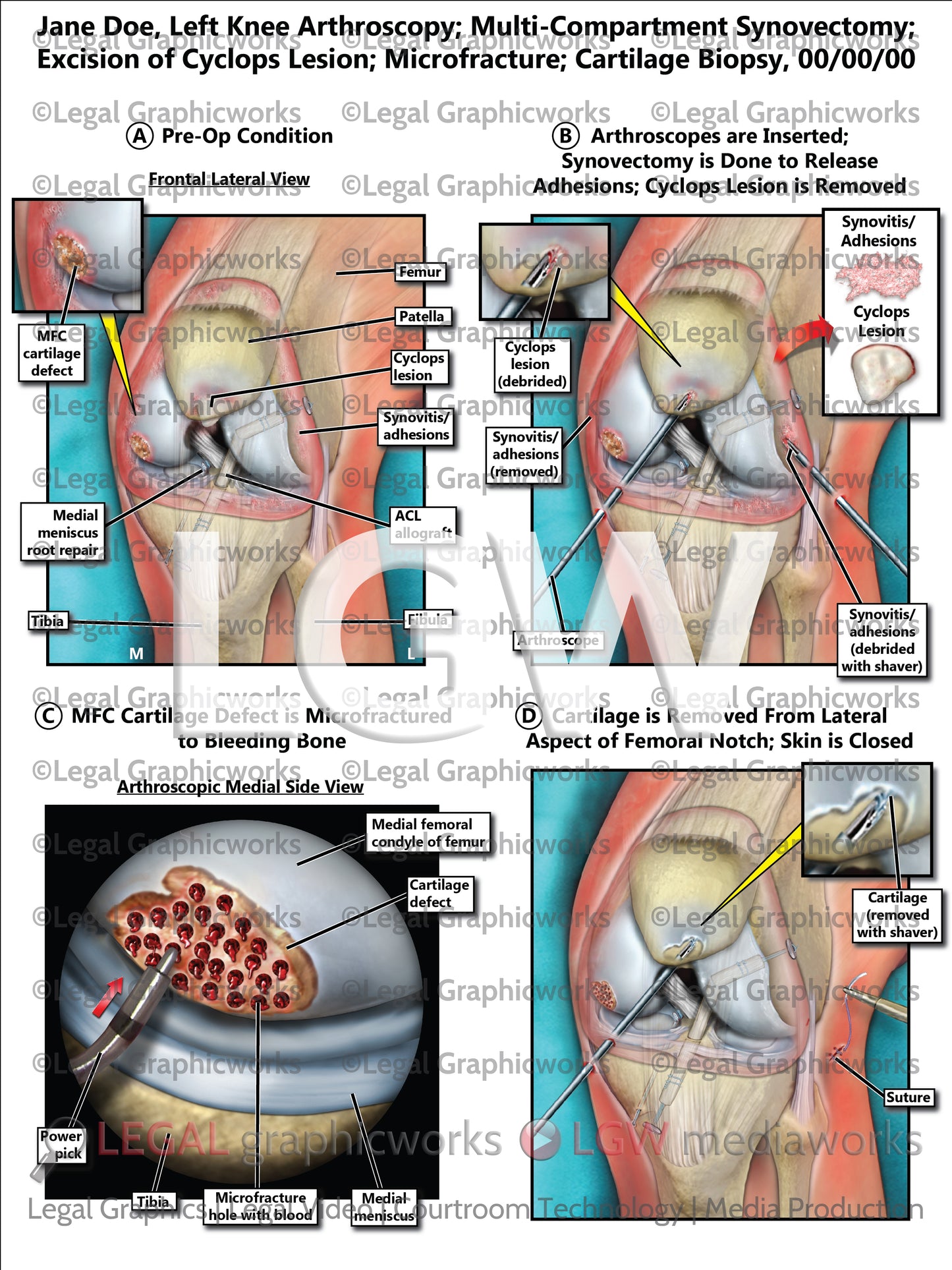 Left Knee Arthroscopy; Multi-Compartment Synovectomy; Excision of Cyclops Lesion; Microfracture; Cartilage Biopsy
