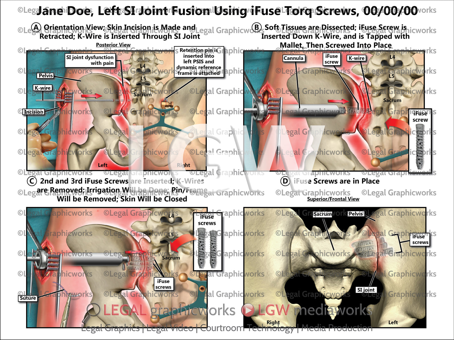 Left SI Joint Fusion Using iFuse Torq Screws