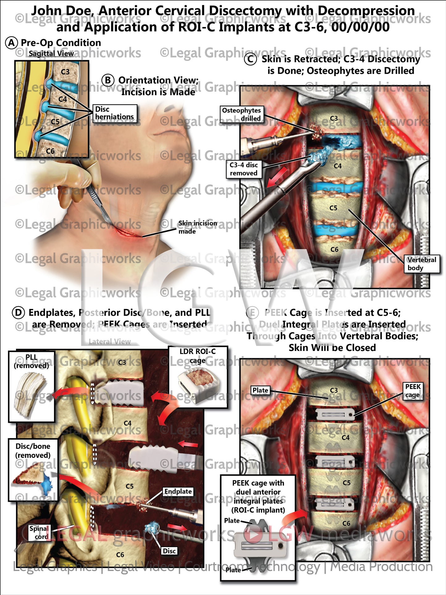 Anterior Cervical Discectomy with Decompression and Application of ROI-C Implants at C3-6