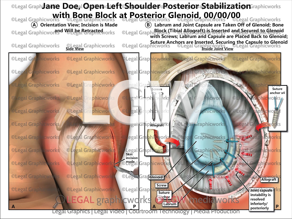 Open Left Shoulder Posterior Stabilization with Bone Block at Posterior Glenoid