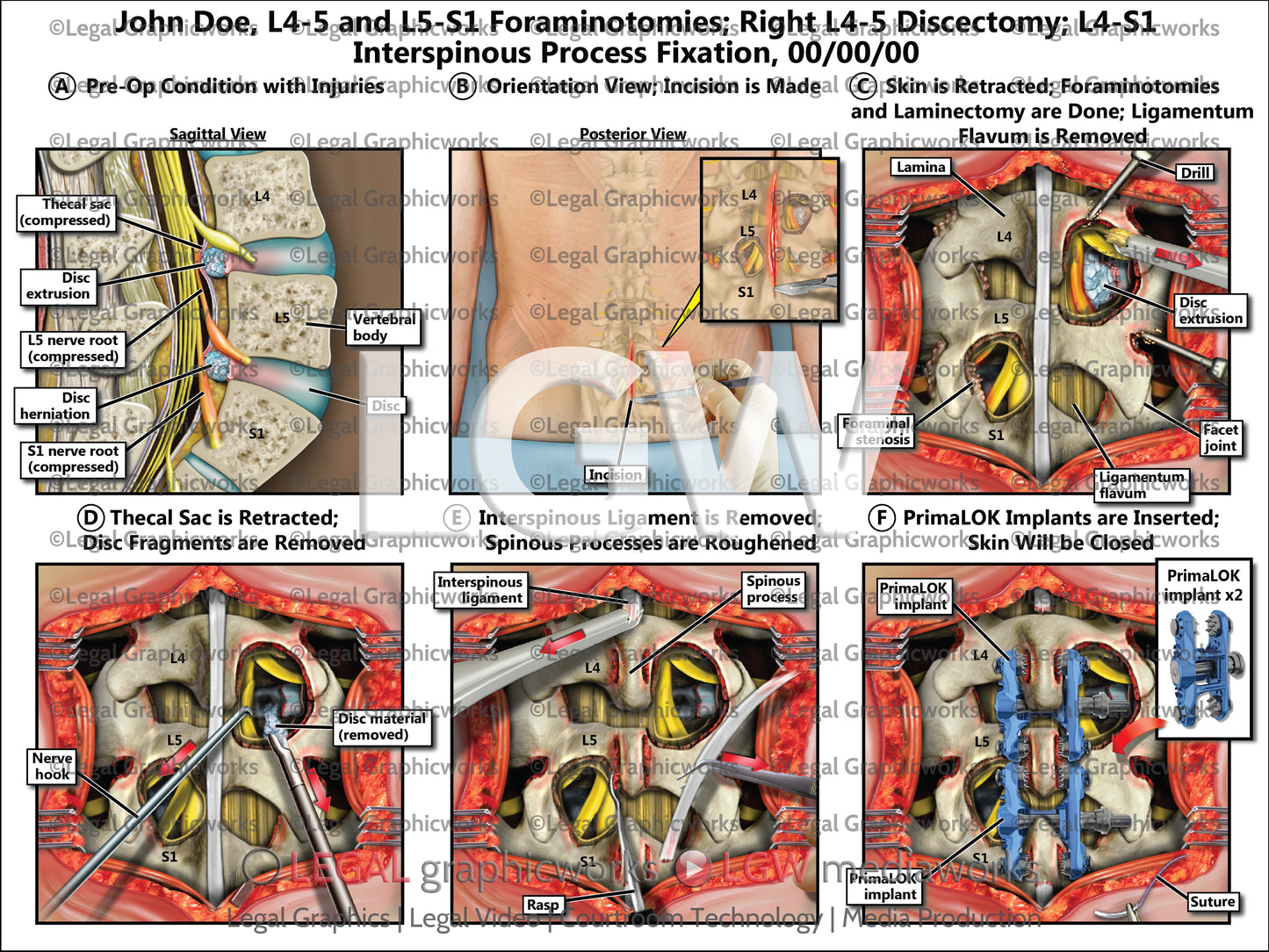 L4-5 and L5-S1 Foraminotomies; Right L4-5 Discectomy; L4-S1 Interspinous Process Fixation