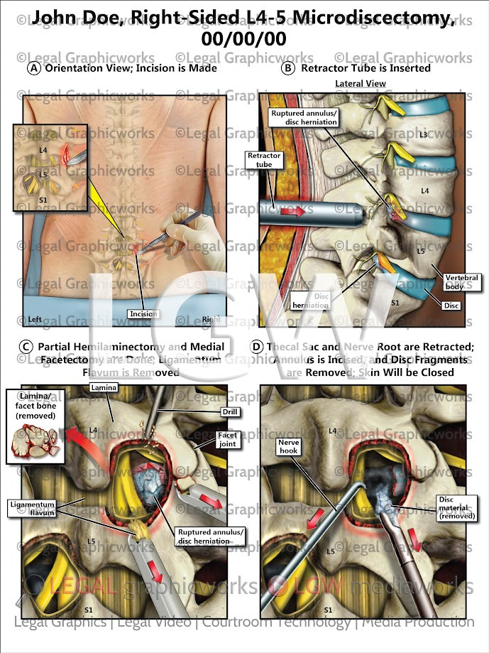 Right-Sided L4-5 Microdiscectomy