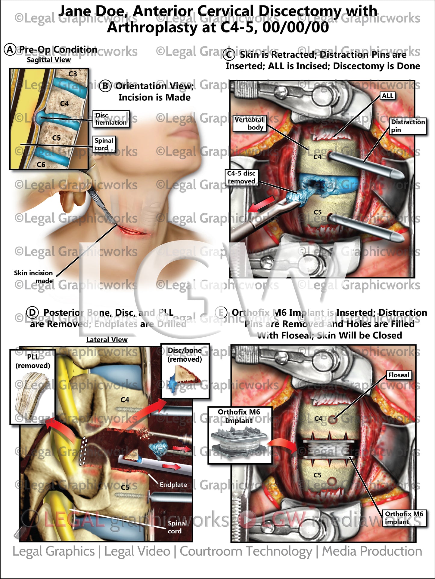 Anterior Cervical Discectomy with Arthroplasty at C4-5