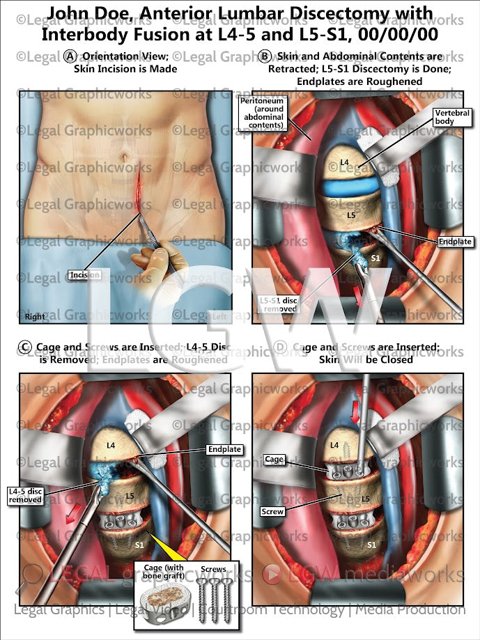 Anterior Lumbar Discectomy with Interbody Fusion at L4-5 and L5-S1