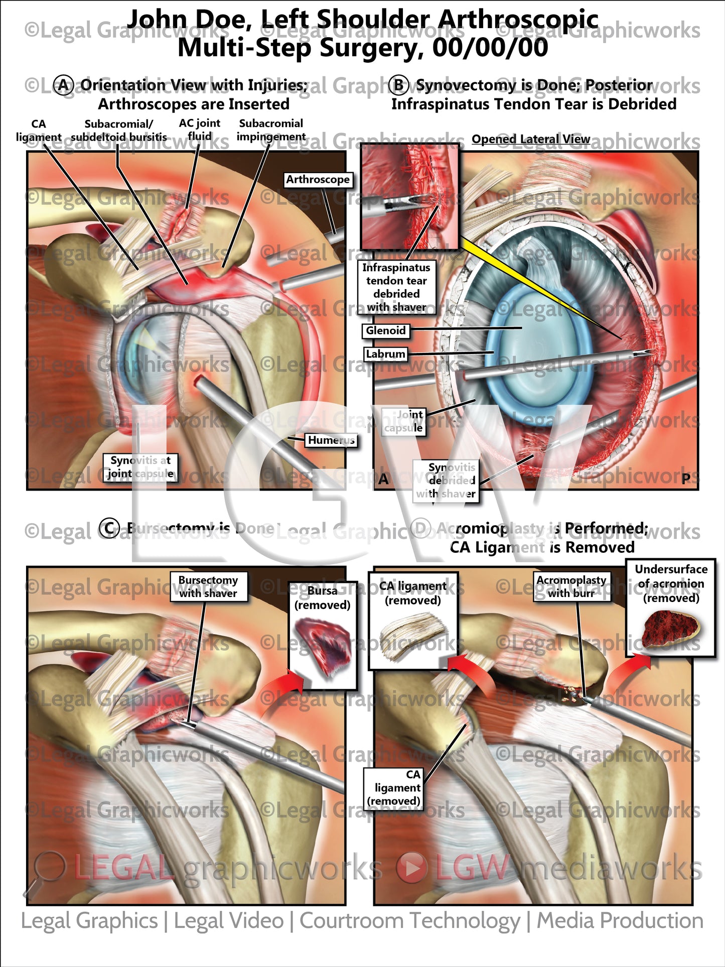Left Shoulder Arthroscopic Multi-Step Surgery