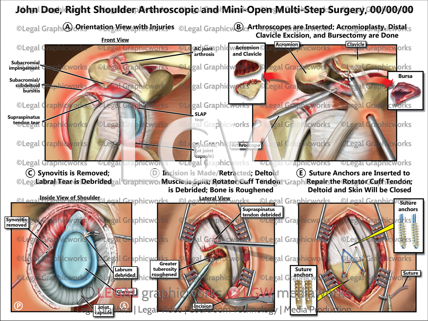 Right Shoulder Arthroscopic and Mini-Open Multi-Step Surgery