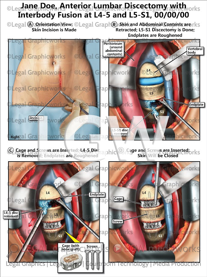 Anterior Lumbar Discectomy with Interbody Fusion at L4-5 and L5-S1